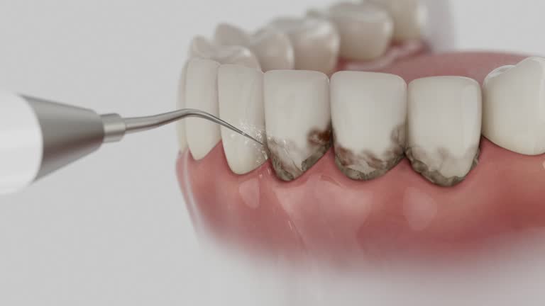 Trusted Wisdom Tooth Removal service in Cuyahoga Falls, OH - Dentist Open Now